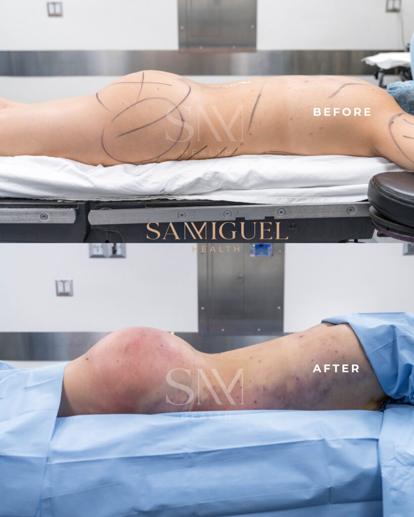Resultado postoperatorio de una cirugía de aumento de glúteos realizada en SanMiguel Health, mostrando un contorno mejorado y natural.