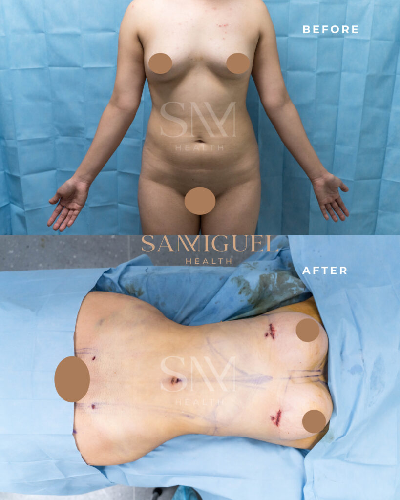 Muestra de los resultados obtenidos de una cirugía de abdominoplastia en SanMiguel Health, con un abdomen más firme y una apariencia rejuvenecida.