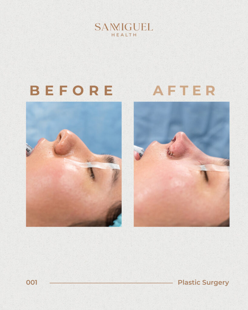 Antes y después de una rinoplastia en SanMiguel Health, destacando una mejora en la forma y proporción de la nariz en el rostro