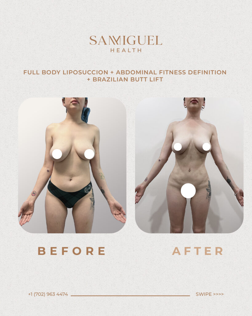 Resultado de Antes y Después de una cirugía de Liposucción y BBL realizada en San Miguel Health