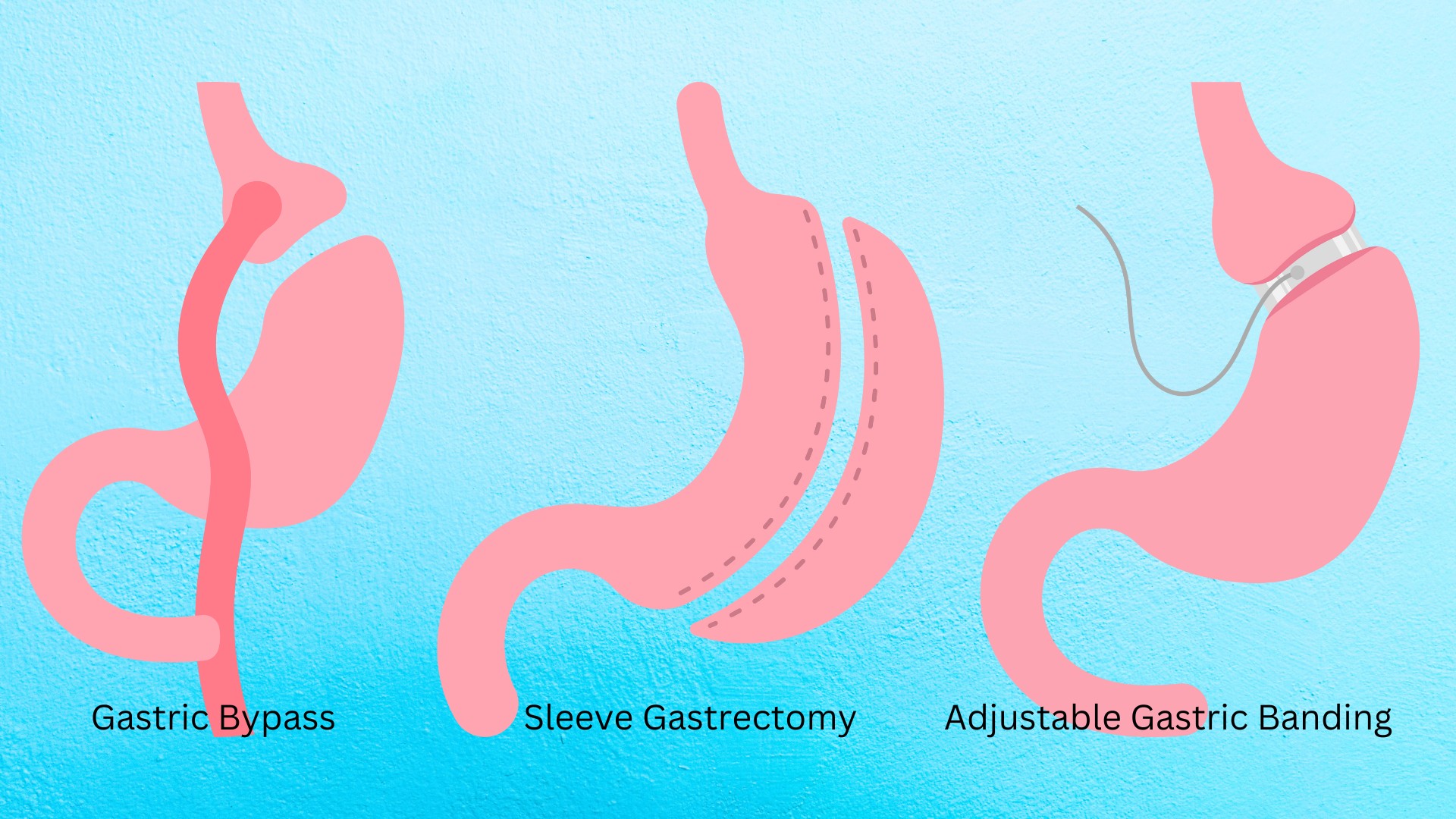 Bariatric Surgery in Tijuana